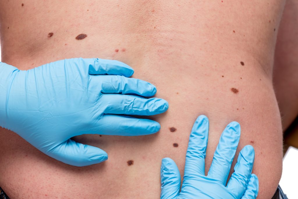 new-melanoma-treatments-are-saving-lives