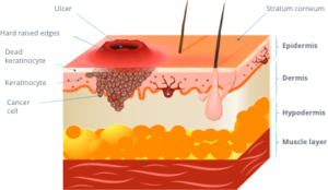 Squamous Cell Carcinoma Austin TX